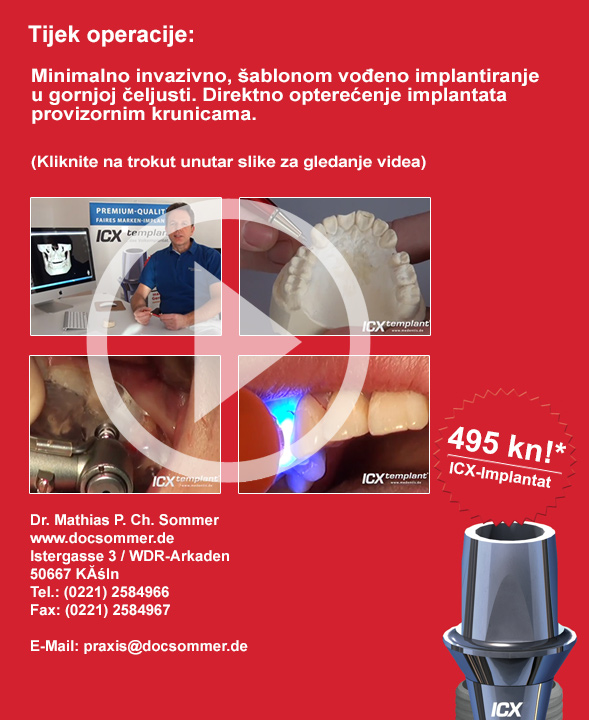 Video ICX Templant